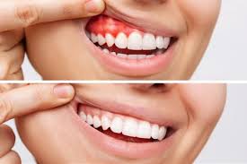 A Complete Guide to Understanding and Treating Bleeding Gums